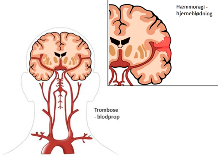 Apopleksi | Neurorehabilitering – Kbh